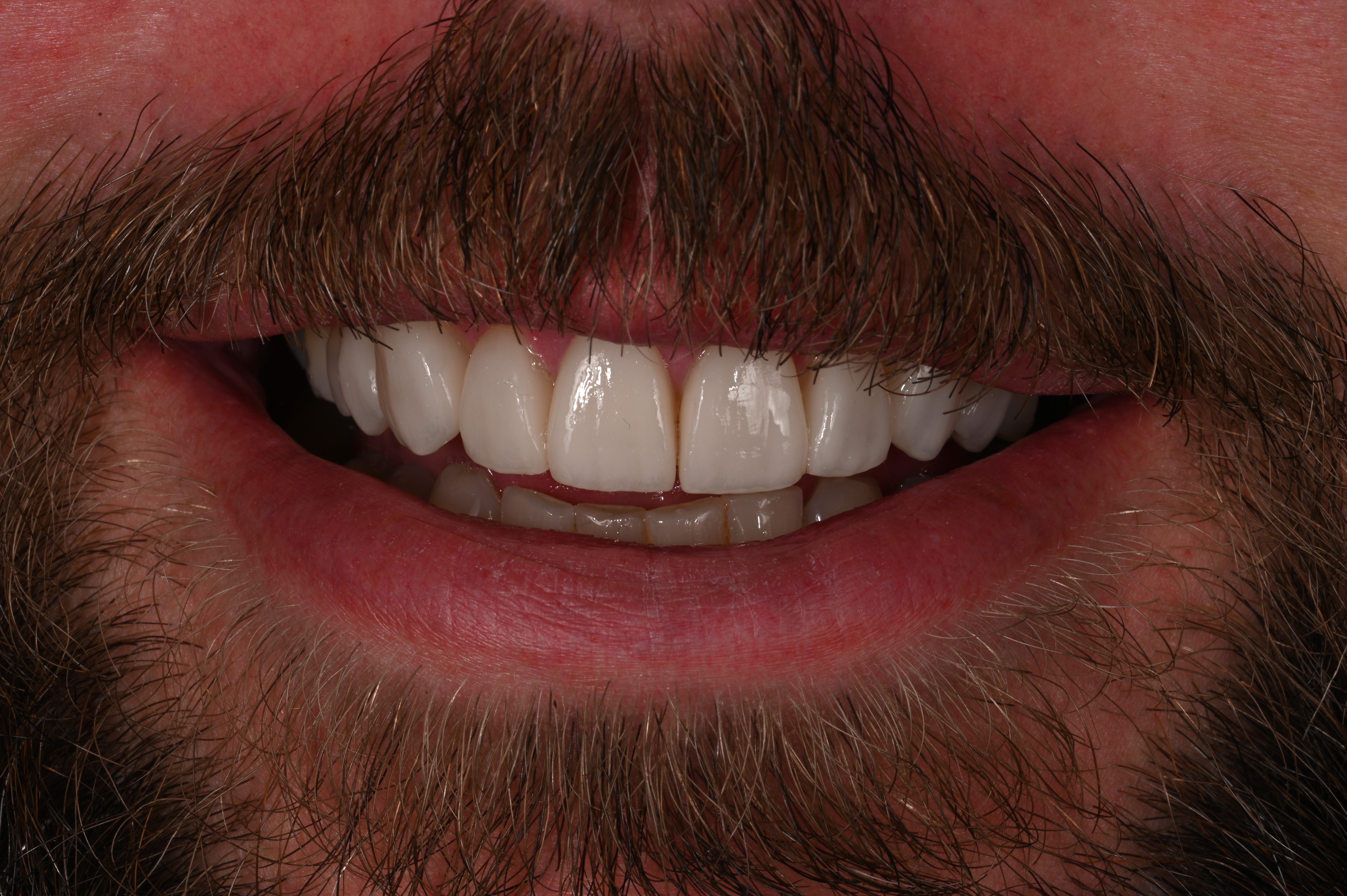 Antes — Reabilitação estética